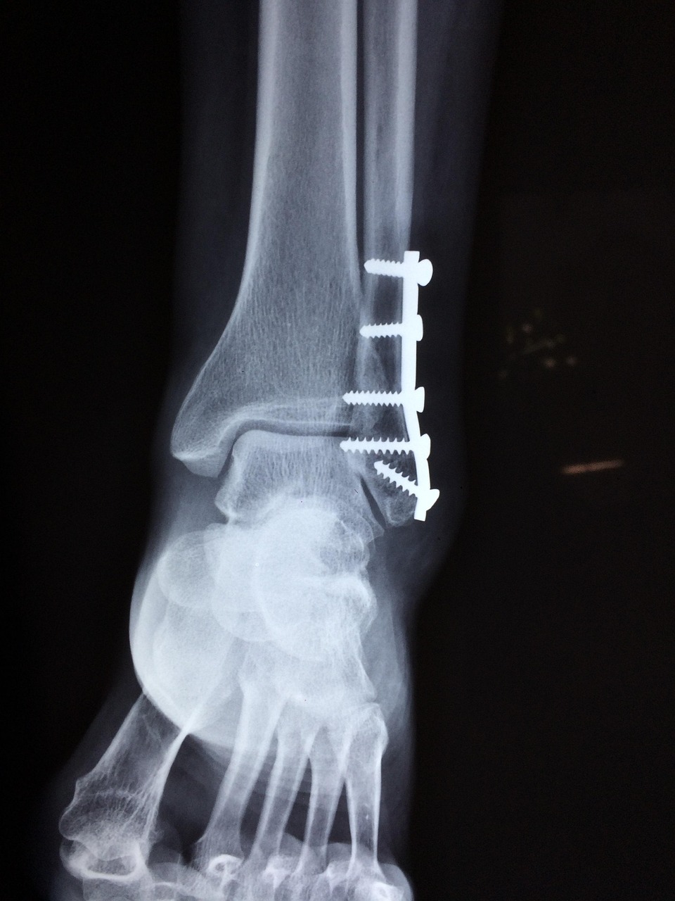 ankle, fracture, foot, medical, accident, trauma, health, injury, leg, pain, patient, bone, care, broken, medicine, hospital, surgery, healthcare, joint, doctor, orthopedic, skeleton, xray, physical, diagnosis, black health, black hospital, black medical, black pain, black doctors, black medicine, black care, black healthcare, ankle, fracture, fracture, fracture, injury, orthopedic, xray, xray, xray, xray, xray